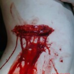 Deep cut on ribs of anorexic woman