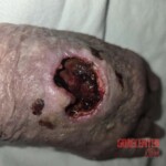Deep wound on hand of old female patient