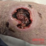 Deep wound on hand of old female patient