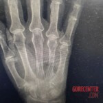 Deep wound on hand of old female patient