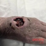 Deep wound on hand of old female patient