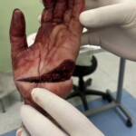 Hand cut up in workplace accident