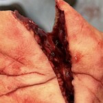 Hand cut up in workplace accident