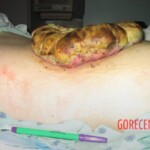 Huge tumor on patient's back