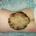 Huge tumor on patient's back