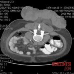 Huge tumor on patient's back