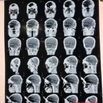 Miracle survival at Dhaka expressway construction site