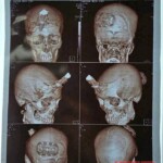 Miracle survival at Dhaka expressway construction site