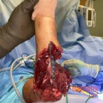 Reconnection of nerves and tendons in the patient's arm