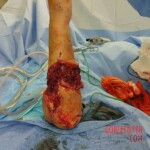 Reconnection of nerves and tendons in the patient's arm