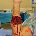 Reconnection of nerves and tendons in the patient's arm