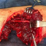 Reconnection of nerves and tendons in the patient's arm