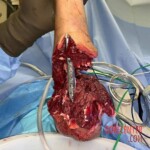 Reconnection of nerves and tendons in the patient's arm