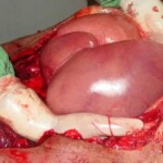 Autopsy of man who died from alcohol poisoning