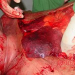 Autopsy of man who died from alcohol poisoning