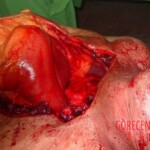 Autopsy of man who died from alcohol poisoning