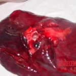 Autopsy of man who died from alcohol poisoning