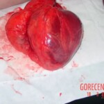 Autopsy of man who died from alcohol poisoning