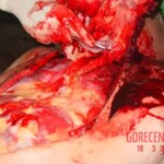 Autopsy of man who died from alcohol poisoning