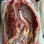 Autopsy photos showing scoliosis