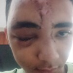 Collision of two motorcycles caused him head injury