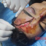 Collision of two motorcycles caused him head injury