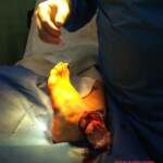 Drunk woman caused herself open ankle fracture