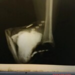 Drunk woman caused herself open ankle fracture