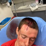 Dude injured his head when he dived into rock