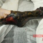 Elderly woman was fused to wheelchair for 8 days