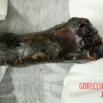 Elderly woman was fused to wheelchair for 8 days