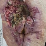 Elderly woman was fused to wheelchair for 8 days