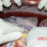 Opening of the sternum, part of the lung Forensic autopsy with educational annotations