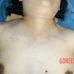 The hands of a corpse. Hematomas 3 Forensic autopsy with educational annotations