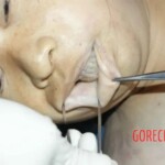 External examination of the gums and lips Forensic autopsy with educational annotations