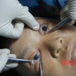 Examination of the eyes 1 Forensic autopsy with educational annotations