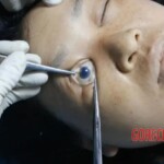 Examination of the eyes 2 Forensic autopsy with educational annotations