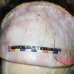 Removing the scalp from the corpse. Measurement Forensic autopsy with educational annotations