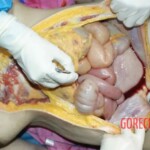Hemorrhage into the anterior abdominal wall 1 Forensic autopsy with educational annotations