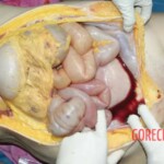 Hemorrhage into the anterior abdominal wall 2 Forensic autopsy with educational annotations