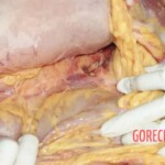 The inside of the abdominal cavity. Hemorrhage Forensic autopsy with educational annotations