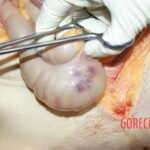Abdominal view, omentum 1 Forensic autopsy with educational annotations