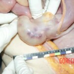 Abdominal view, omentum 2 Forensic autopsy with educational annotations