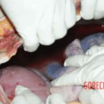 Opening the sternum Forensic autopsy with educational annotations