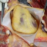 Heart detailed. Obesity 1 Forensic autopsy with educational annotations