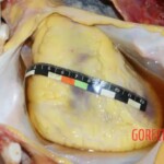 Heart detailed. Obesity 2 Forensic autopsy with educational annotations