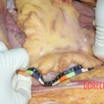 Lower esophagus, hemorrhage 1 Forensic autopsy with educational annotations