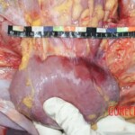 Kidney. Measurement Forensic autopsy with educational annotations