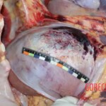 Liver, kidney, hemorrhage Forensic autopsy with educational annotations