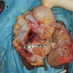 Liver, stomach Forensic autopsy with educational annotations